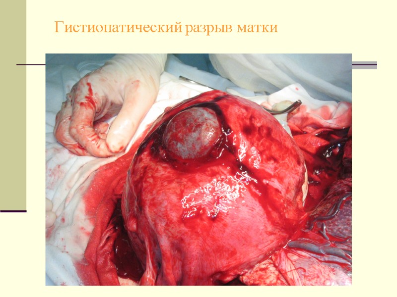 Гистиопатический разрыв матки